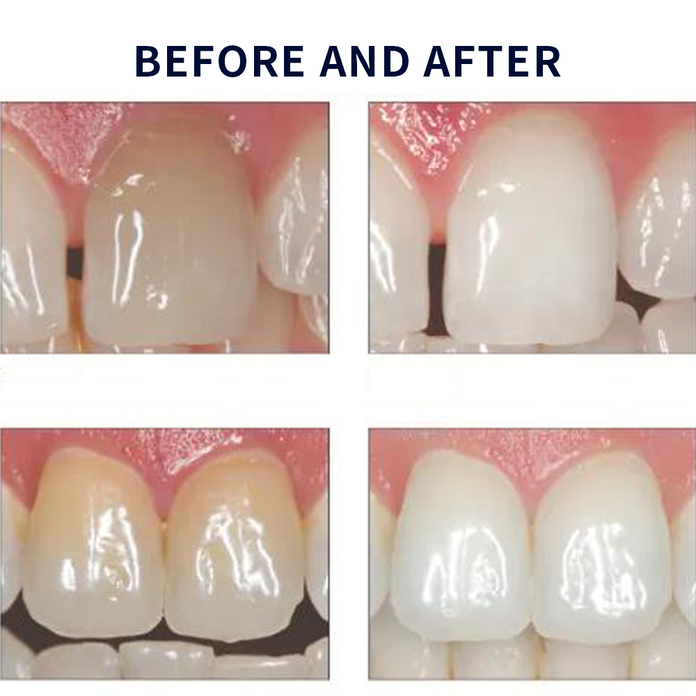 유백광 미백 20% PF 20 16 젤 키트, 초강력  - Teeth Whitening Gels Used By Dentists 리뷰 및 가격