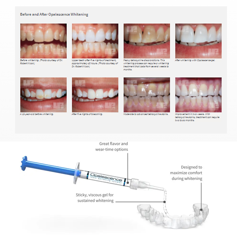 유백광 미백 20% PF 20 16 젤 키트, 초강력  - Teeth Whitening Gels Used By Dentists 리뷰 및 가격