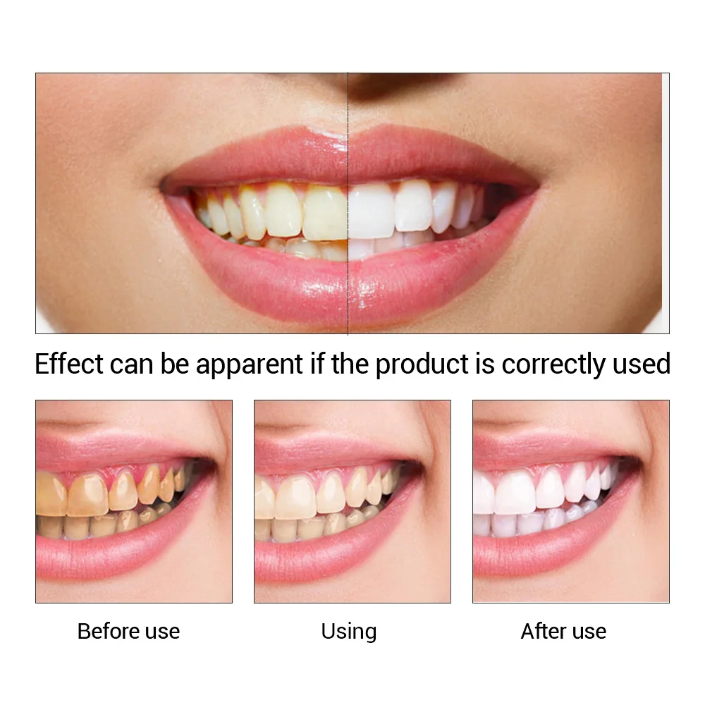 FTEENPLY 치아 미백 에센스 파우더 구강 위생 청 - Teeth Whitening Results 리뷰 및 가격