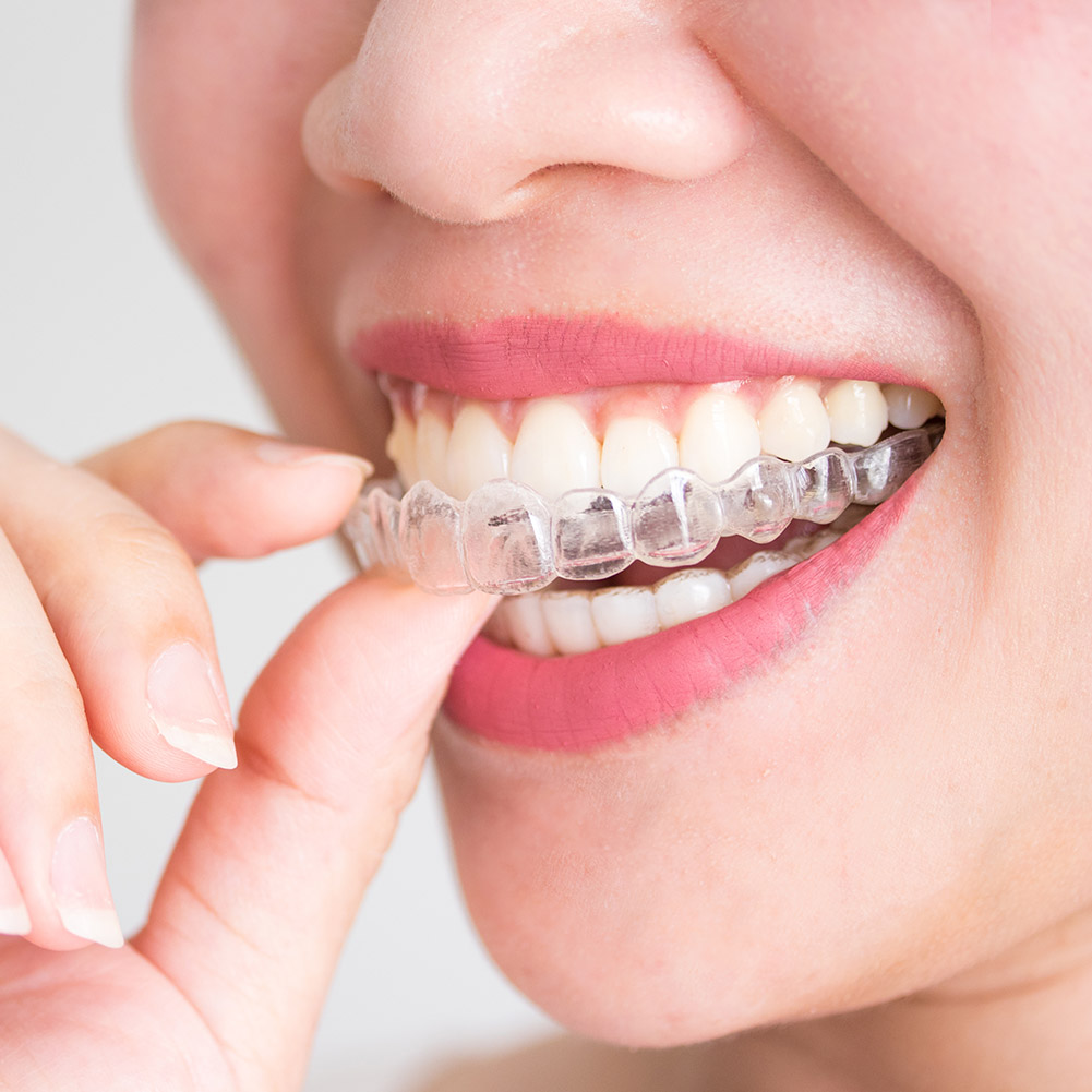 2/4개입 전문 치아 교정기 세트 투명 마우스가드 위생 - Teeth Whitening For Trays 리뷰 및 가격