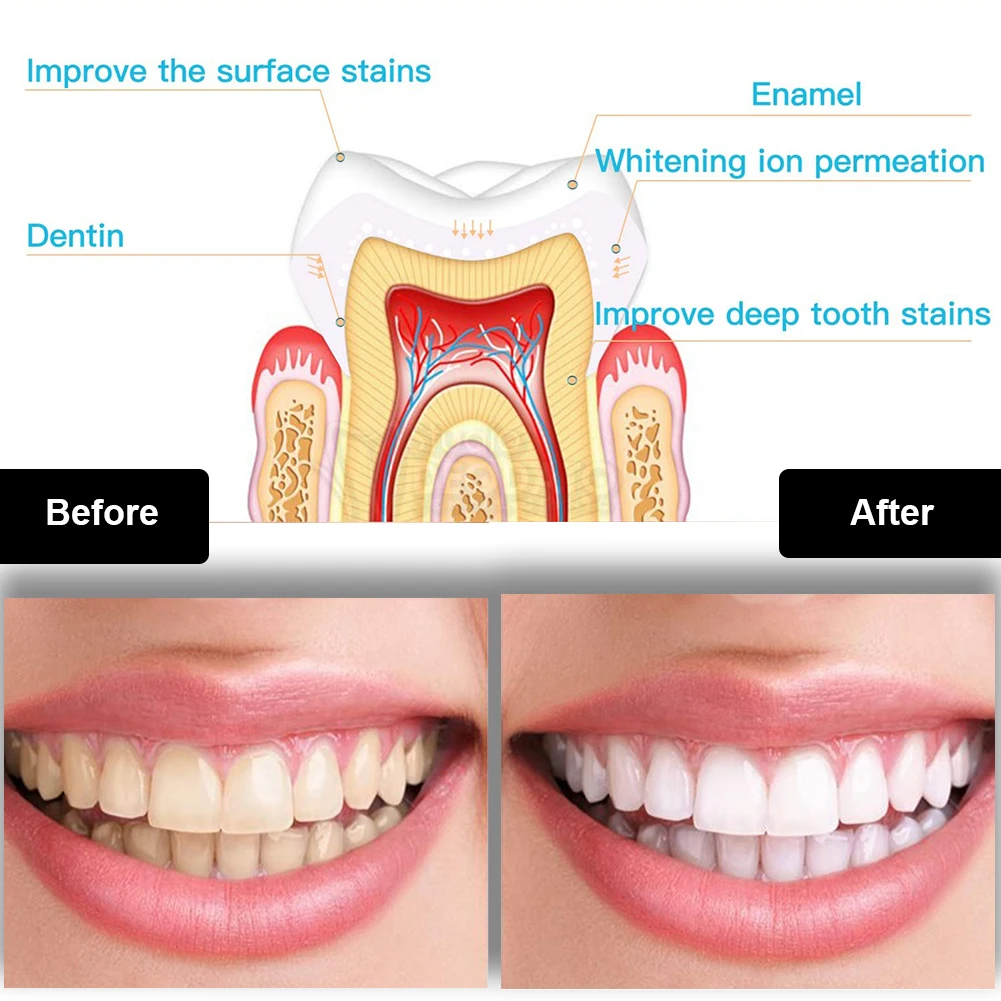 치과 치아 미백 키트 미니 16 LED 콜드 라이트 3 - Teeth Whitening Results 리뷰 및 가격