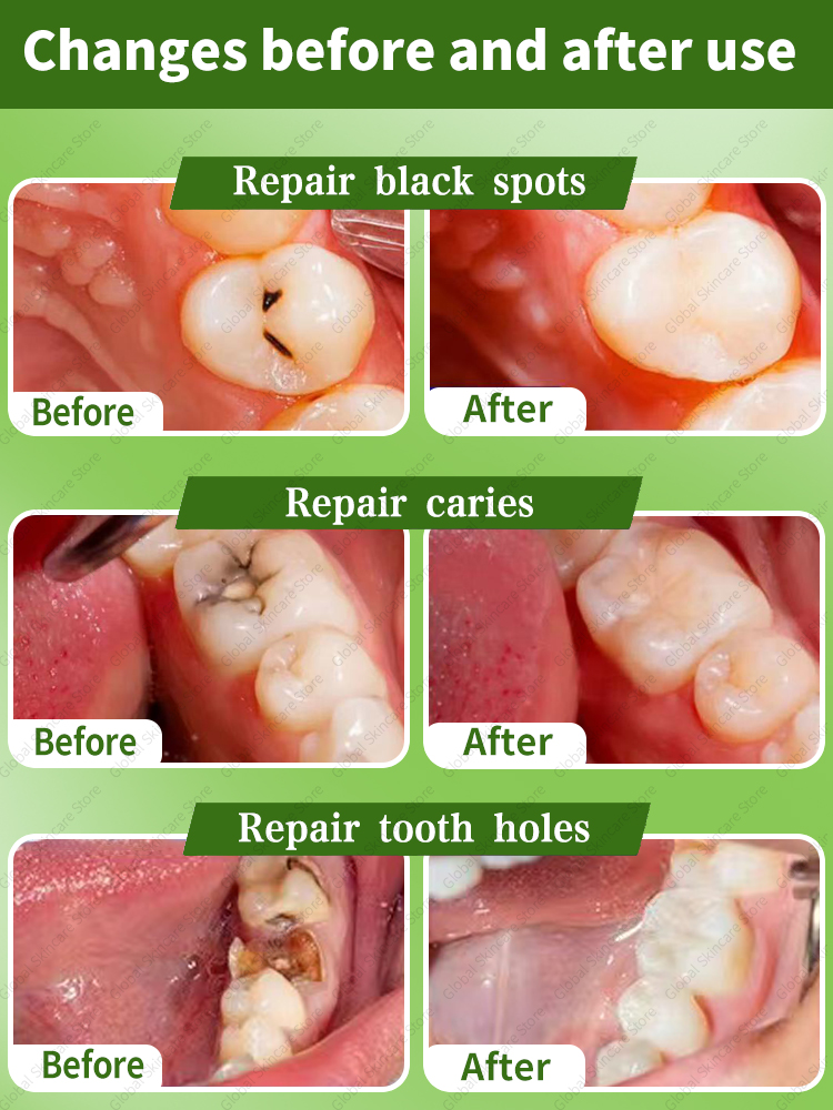 부패 치아 수리 충치 수리 충치 방지 보호 - Teeth Whitening Charcoal Powder 리뷰 및 가격